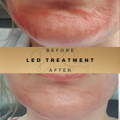 Before & After Pictures Dr Sknn Wilmslow Cheshire