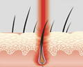 lllt therapy growth, laser hair growth with lllt, low level laser therapy hair growth