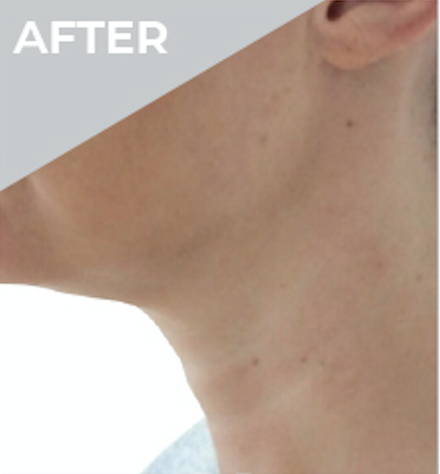 Dr Sknn Non-Surgical Face & Neck Lift After