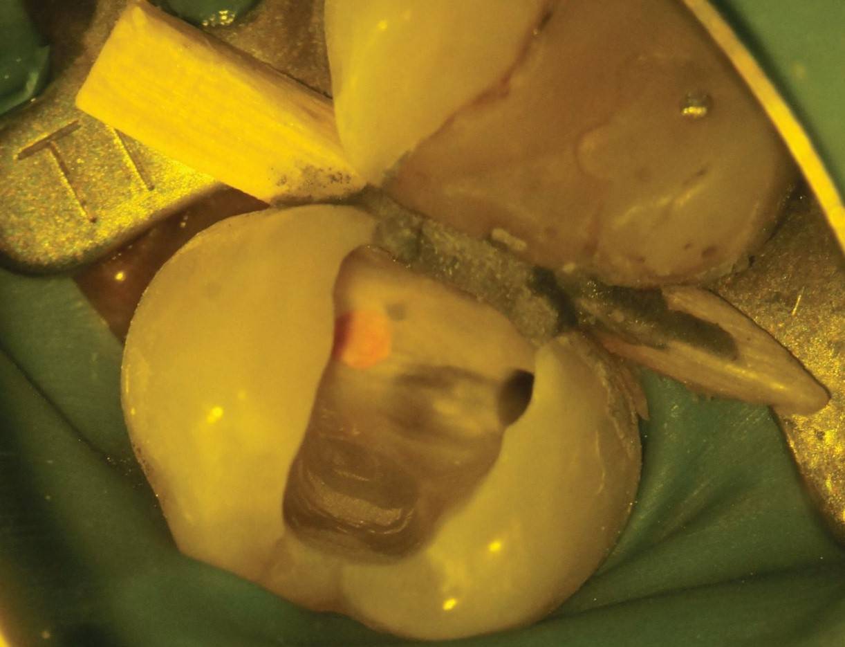 Etched tooth with coronal access and post space.