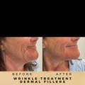 Perioral Line Fillers Wilmslow Before & After
