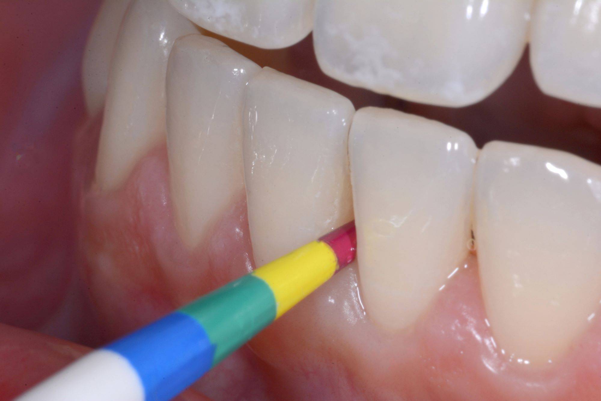 Gauge with colour coded tip inserted in between teeth