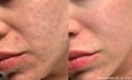 Cheek with acne scarring before and after Morpheus8