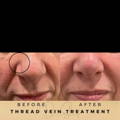 Before & After Pictures Dr Sknn Wilmslow Cheshire