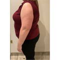 ARM FAT REDUCTION - SINGLE SESSION - AFTER