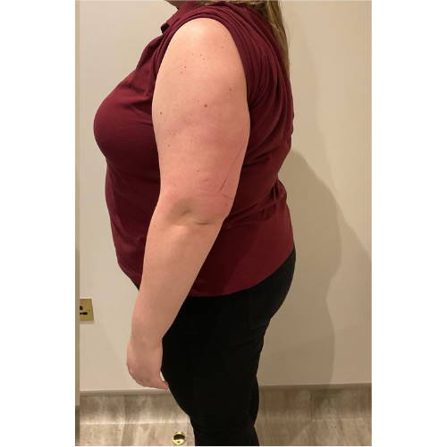 Dr Sknn Arm Fat Reduction After
