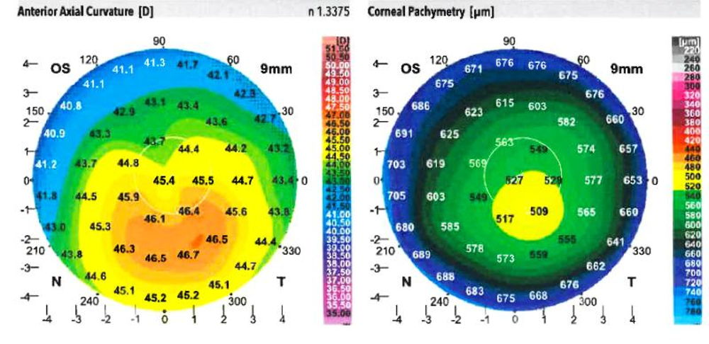 Cornea maps for stage 1 of keratoconus