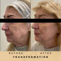 Jawline fillers Dr Sknn Before & After Picture