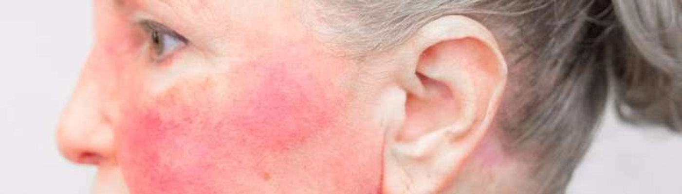 16 Warning Signs of Lupus to Watch Out For