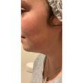 ONDA - NON-SURGICAL FAT REDUCTION, CELLULITE REDUCTION & SKIN TIGHTENING - after picture Submental / Neck