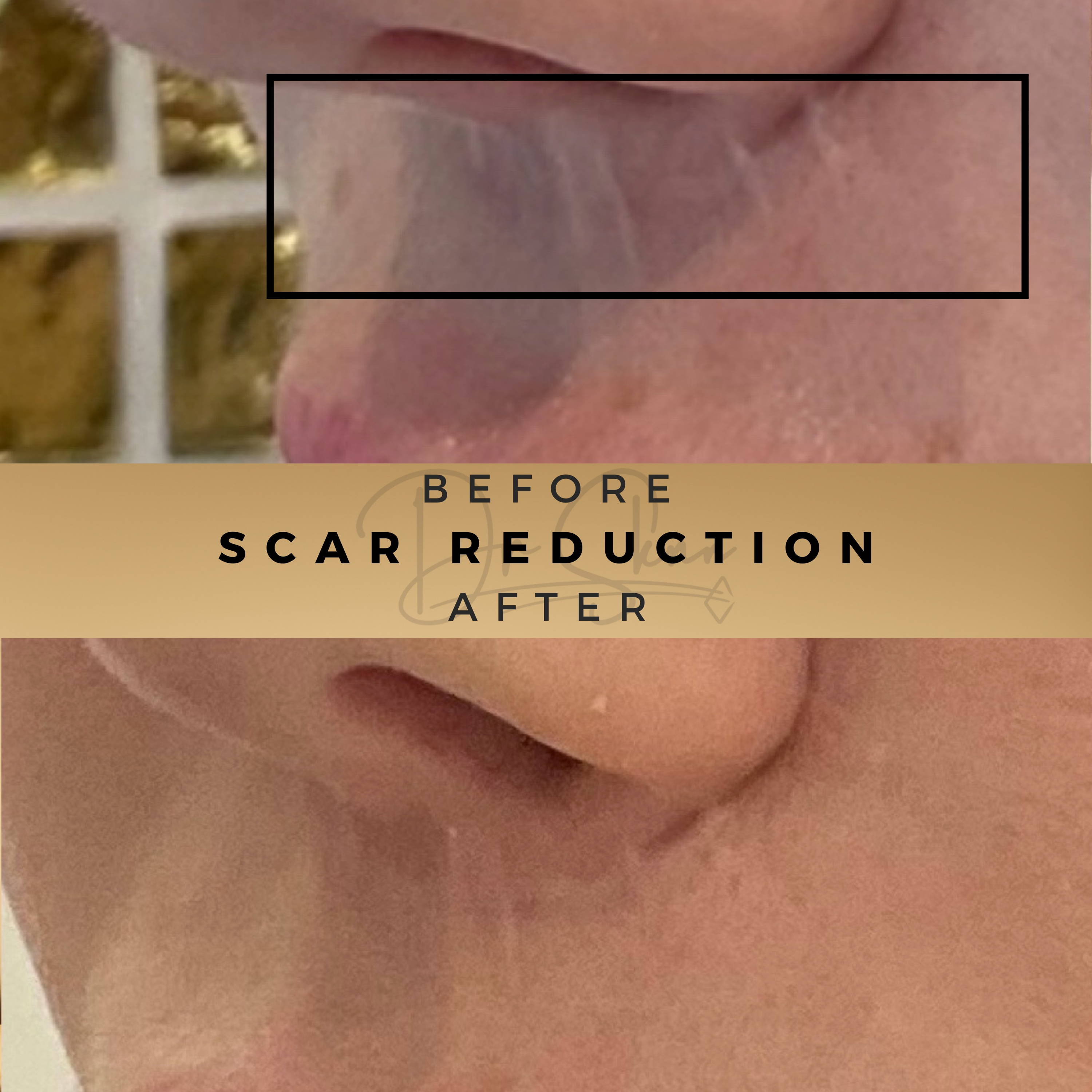 Scar Treatment Wilmslow Before & After Dr Sknn