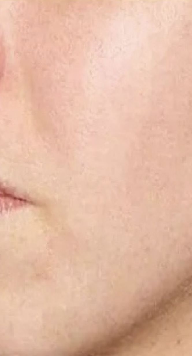 Skin during week 3 of use