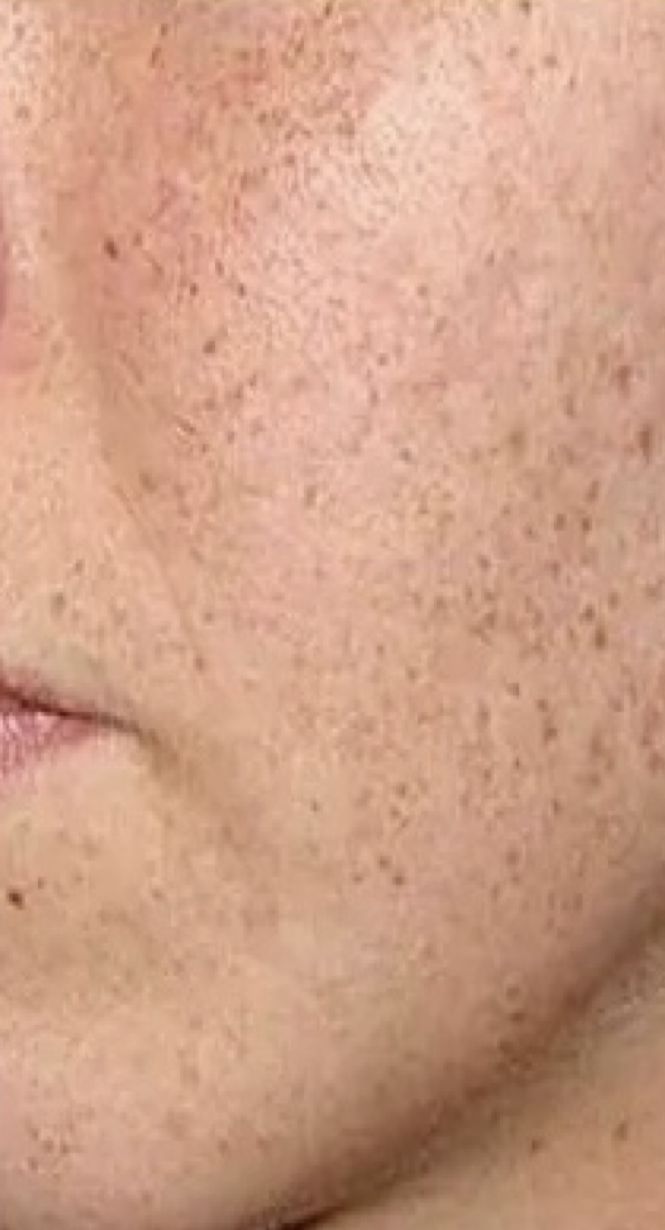 Skin during week 1 of use