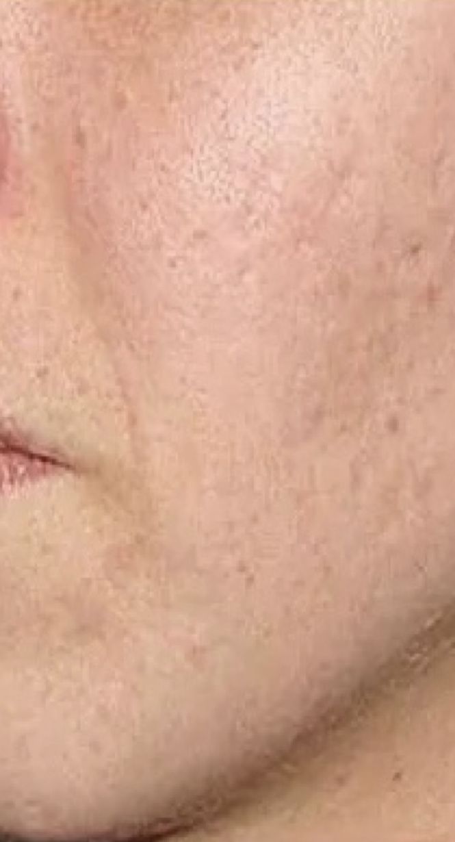 Skin during week 2 of use