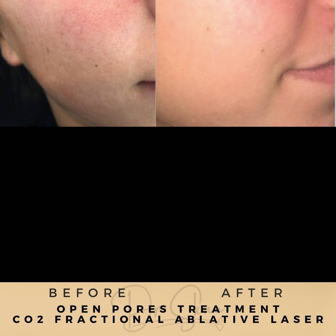 Open Pore Treatment Wilmslow Before & After Dr Sknn