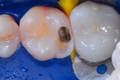 Posterior Restoration: before the Bioclear Method