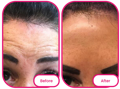 the forehead before and after taking the best collagen gummies from reviews 