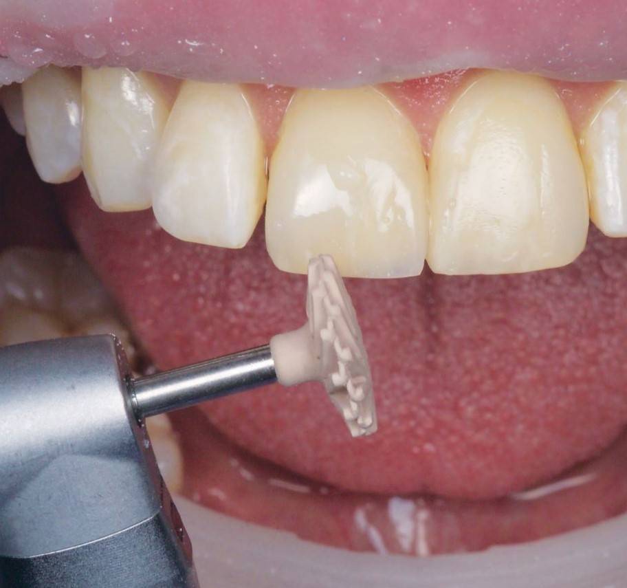 Beige polisher approaching restored tooth