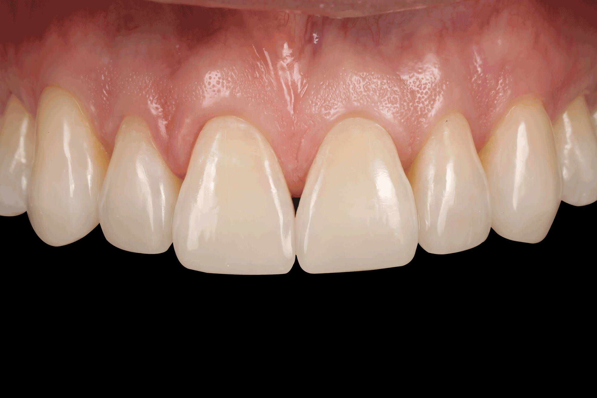 final restored upper anterior teeth in black background