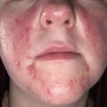 INTENSE PULSED LIGHT (IPL) - LIGHT ASSISTED ACNE TREATMENT After Picture