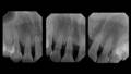 X-ray of pre operative black triangle