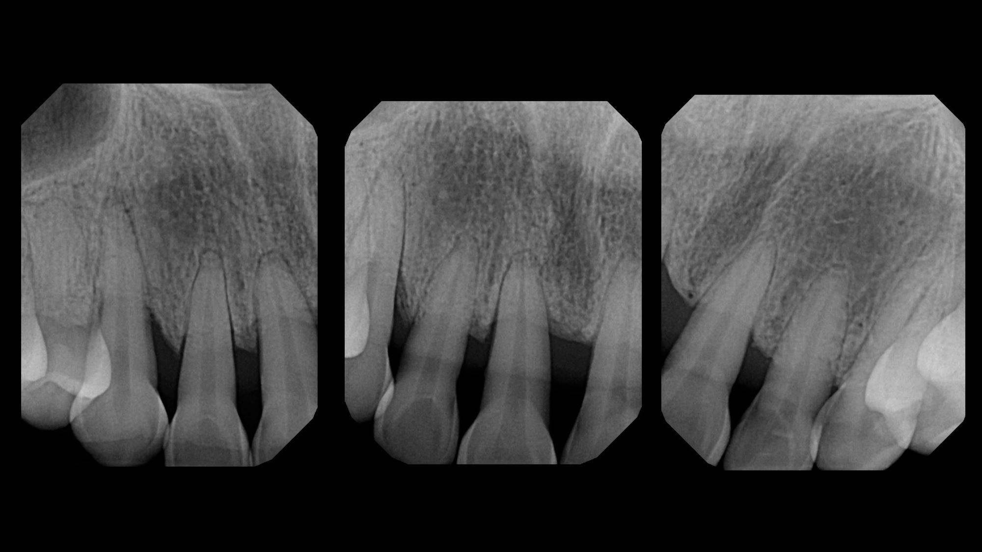 X-ray of pre operative black triangle