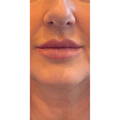 Dermal Fillers - Lip Fillers - Before