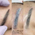 The before, during, and right after pigment removal