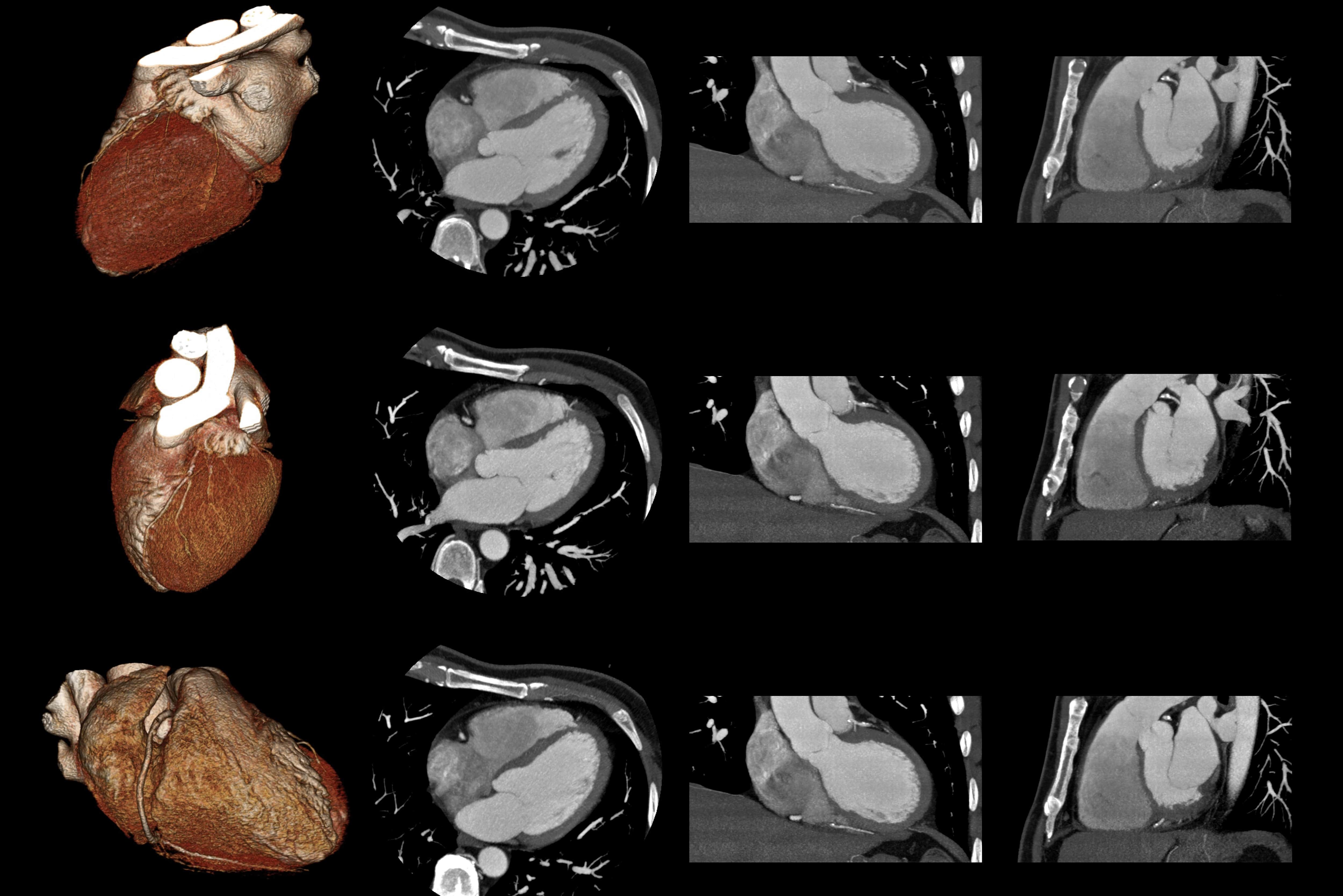 Cardiac CT Cardiac Computerized Tomography Capital Area 