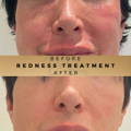 Before & After Pictures Dr Sknn Wilmslow Cheshire