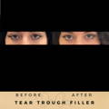 Tear Trough Fillers Wilmslow