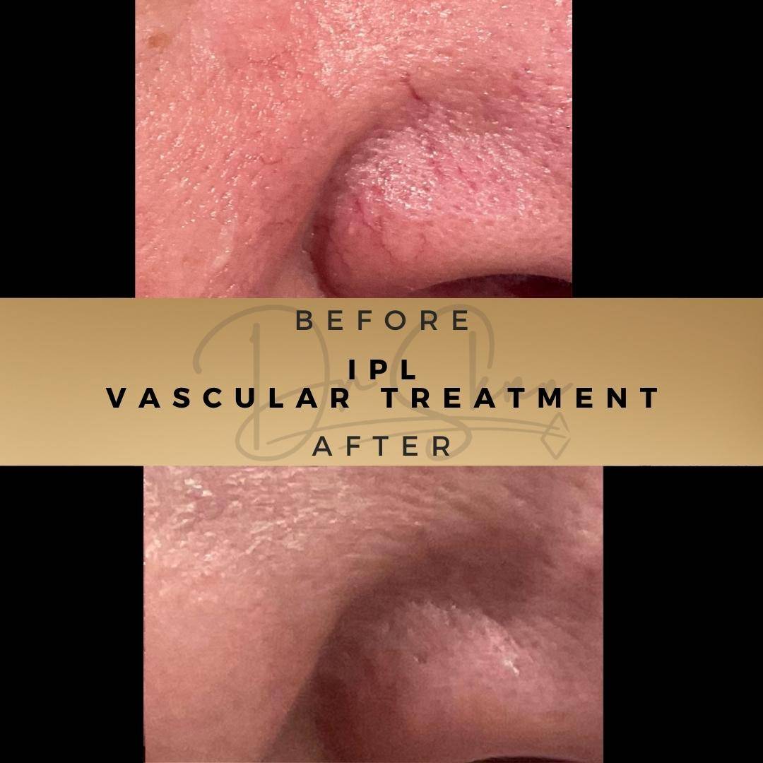 Vascular Treatment Thread Vein Treatment Wilmslow Before & After Dr Sknn