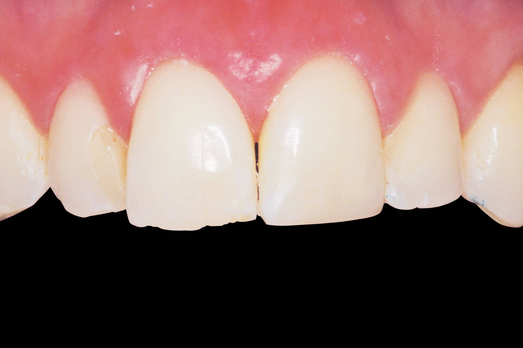 upper teeth before restoration in black background