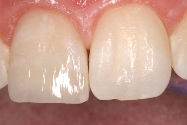 Teeth with light layer of composite