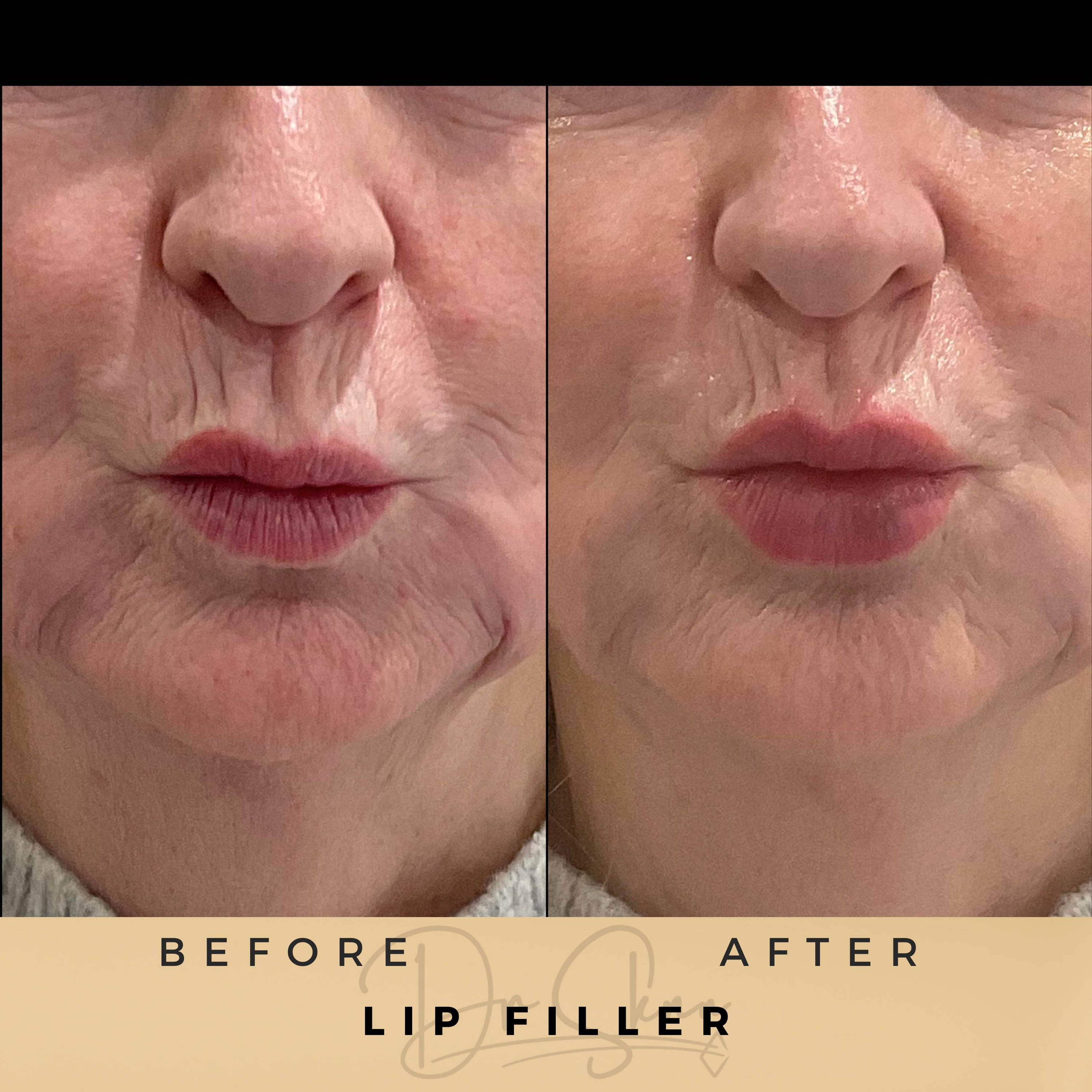 Lip Fillers - Dr Sknn before and after