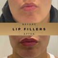 Lip Fillers Wilmslow with Anti-wrinkle injections