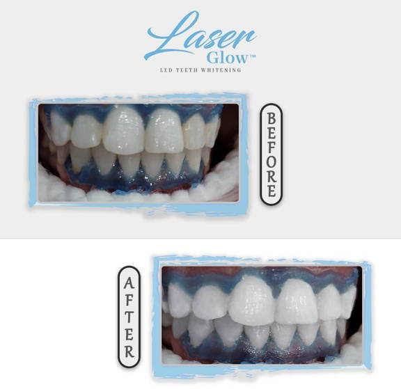 how to whiten my teeth fast