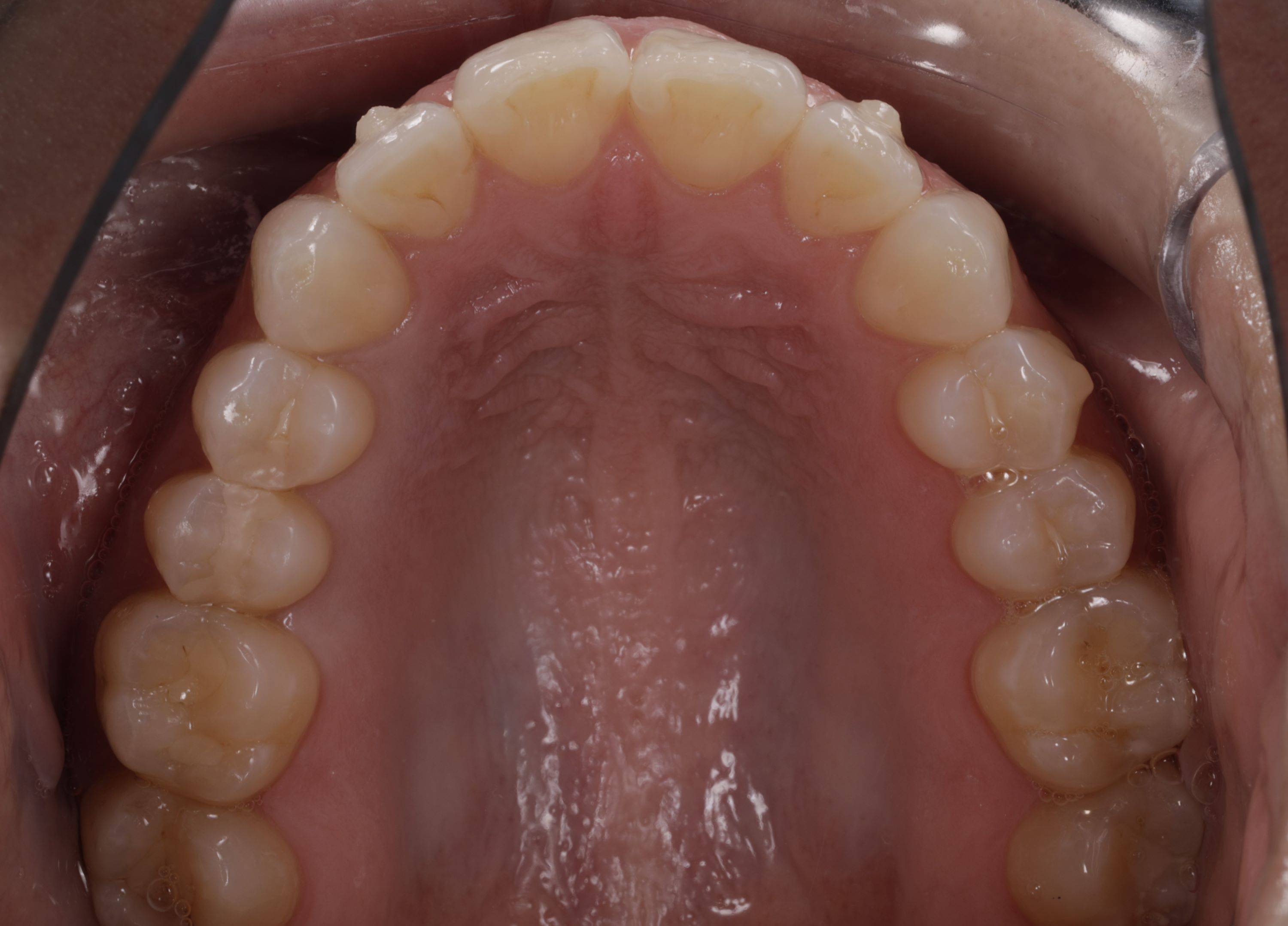 Uper dental arch