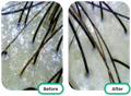 before and after of the scalp after using the best tea tree oil singapore