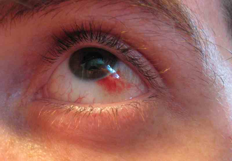 What Causes Blood In Eye After Lasik?