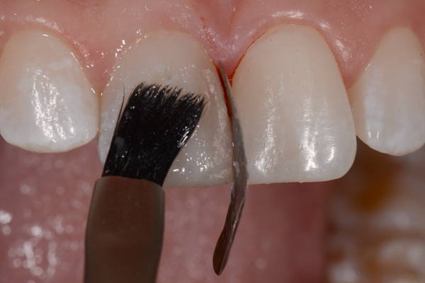 black brush brushing resin into tooth