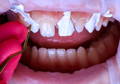 teeth with PTFE tape applied