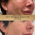 Liquid Facelift Wilmslow with Anti-wrinkle injections