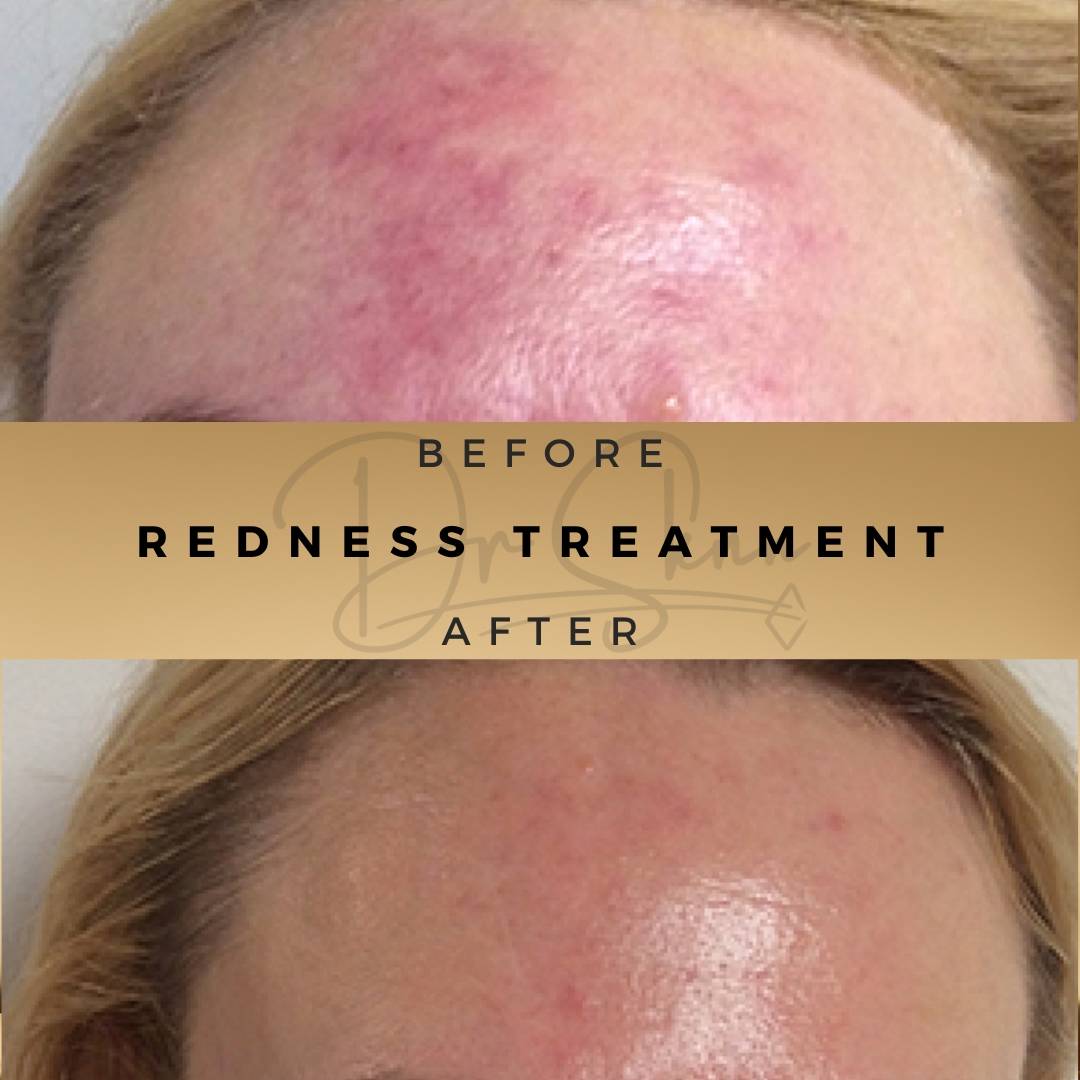 Redness Treatment Wilmslow Before & After Dr Sknn