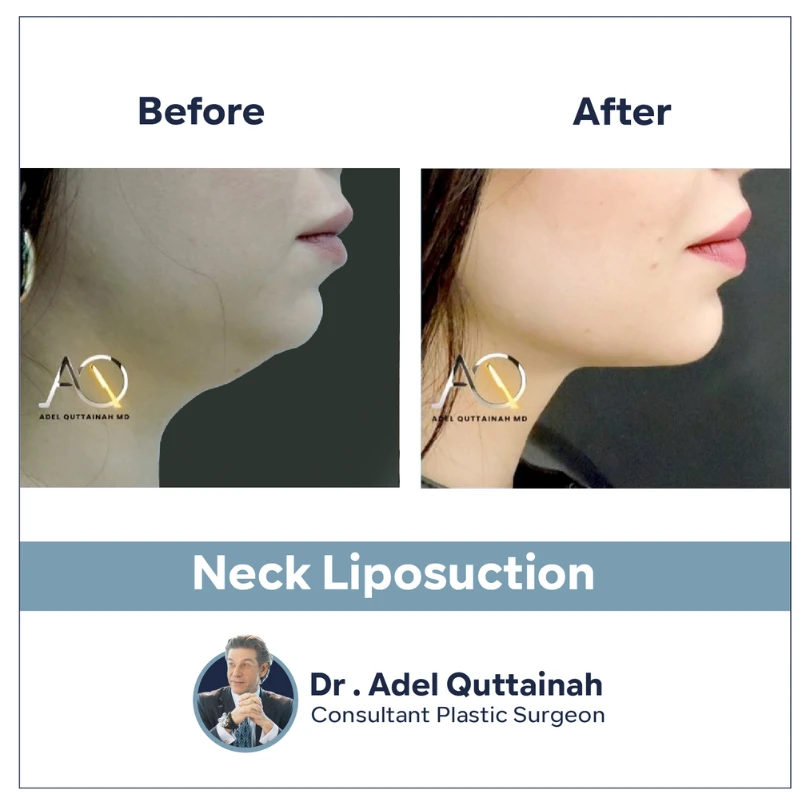 Face and Neck lift in dubai