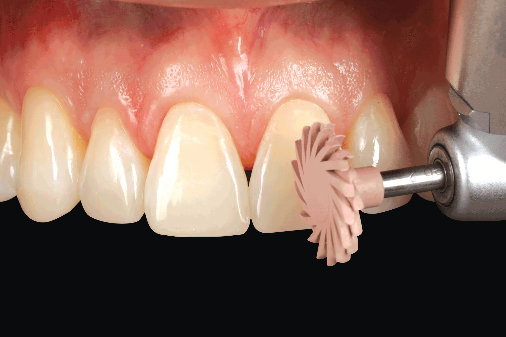 pink polisher polishing central incisor