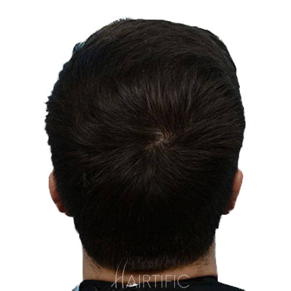 laser helmet for hair growth, lllt for hair growth, laser helmet, laser cap