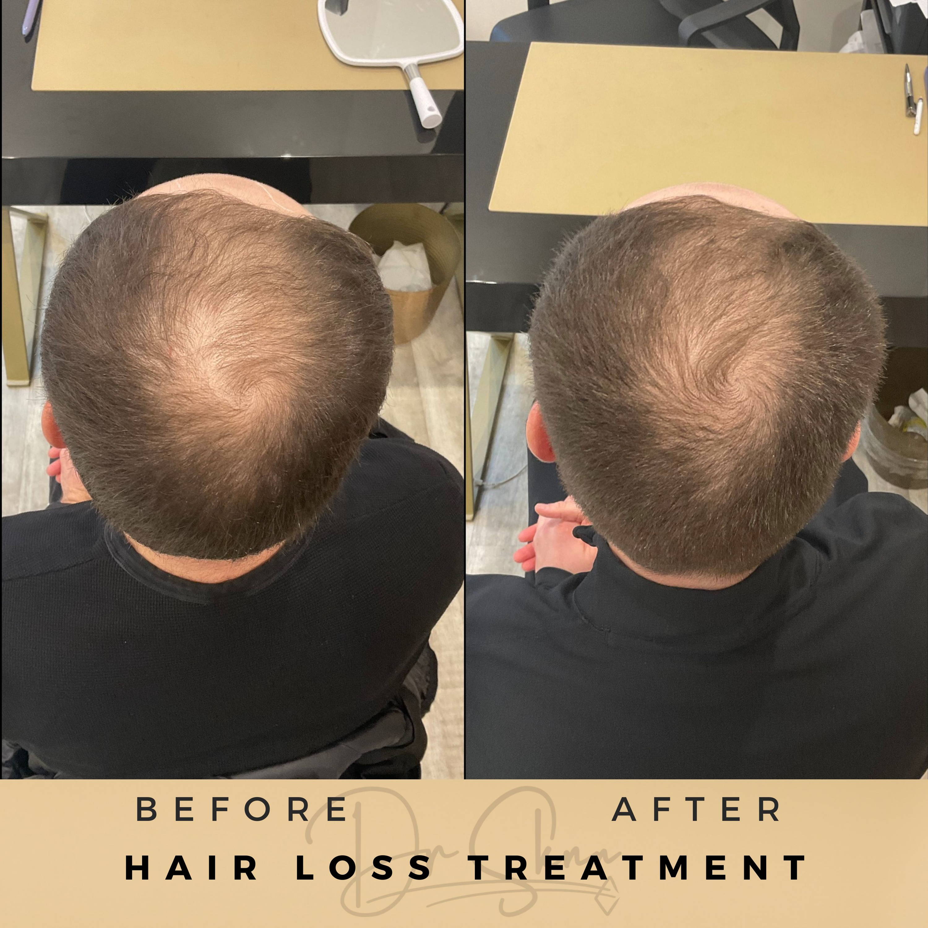 hair loss treatment / hair regrowth