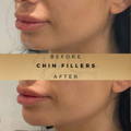 Chin Fillers Wilmslow Before & After Dr Sknn