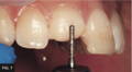 Skinny bur touching anterior tooth